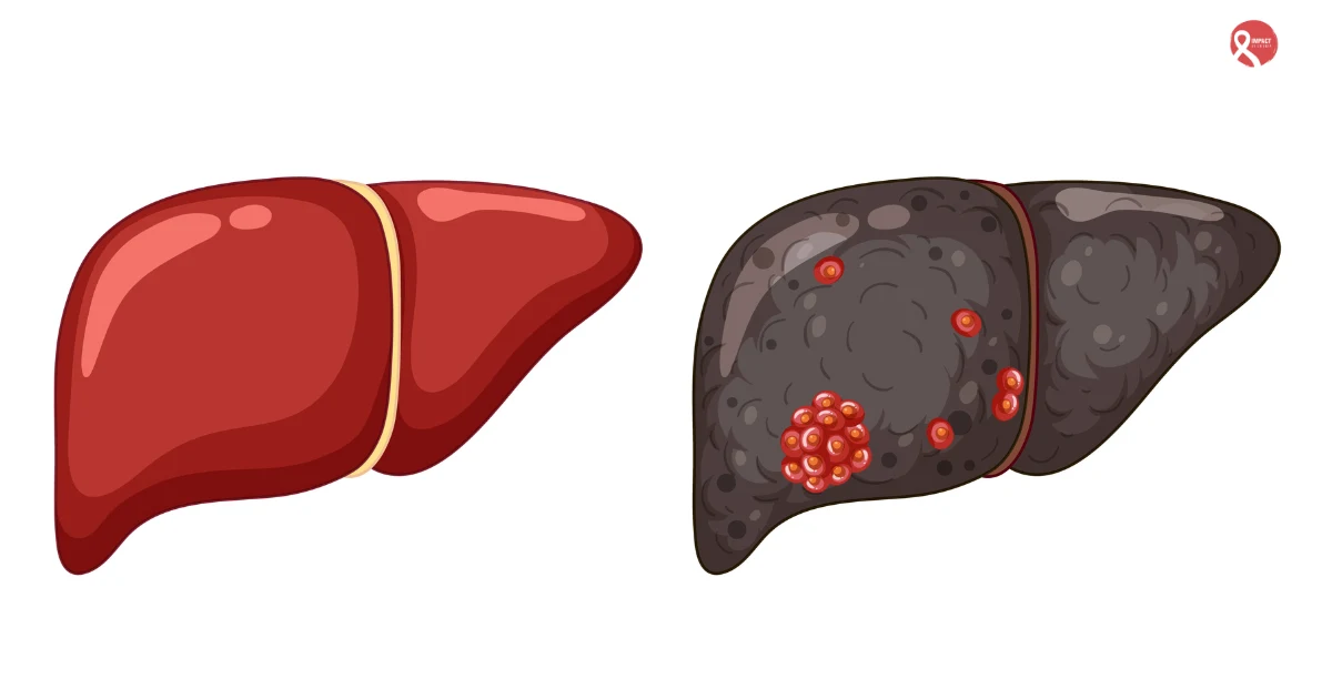 Medical illustration of liver cancer showing abnormal cell growth and disease progression.