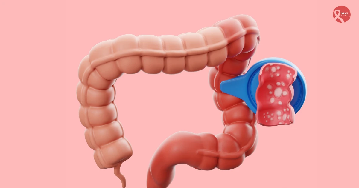 3D illustration of colon highlighting advanced cancer growth in the large intestine, representing Stage 4 colon cancer progression.