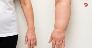 A woman with swelling in one arm due to lymphedema following breast cancer surgery, shown in a simple clinical setting.